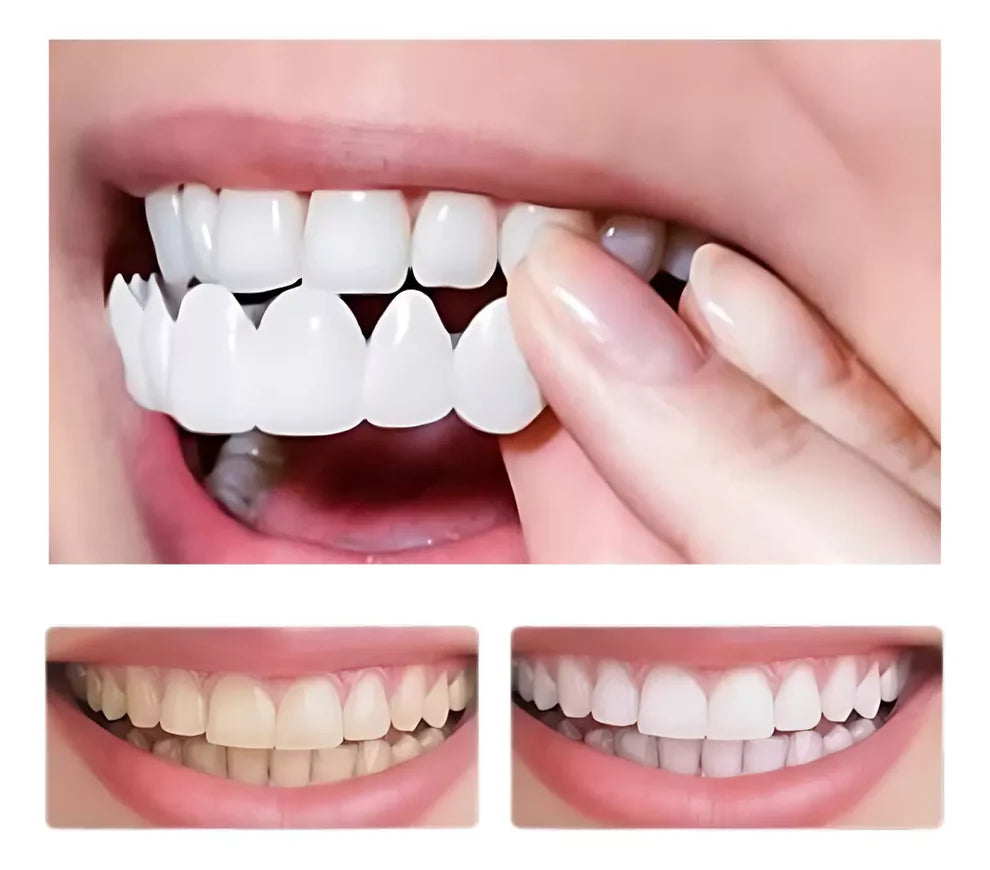 Carillas Dentales SnapMile | Luce una Sonrisa Soñada